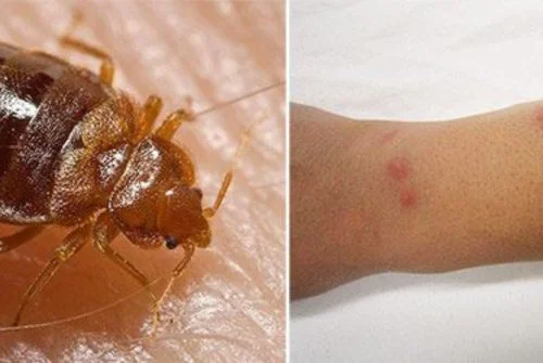 شكل قرصة البق